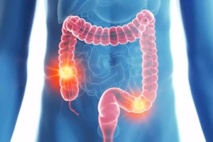 Cancers du pancréas et du côlon: Des Belges développent une nouvelle thérapie cancer colon